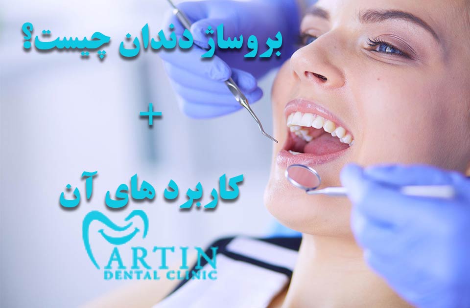 بروساژ دندان چیست+کاربرد آن