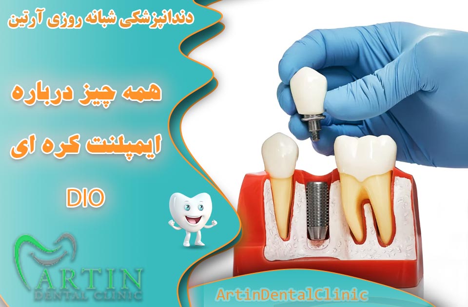 همه چیز درباره ایمپلنت‌های دندانی کره ای DIO
