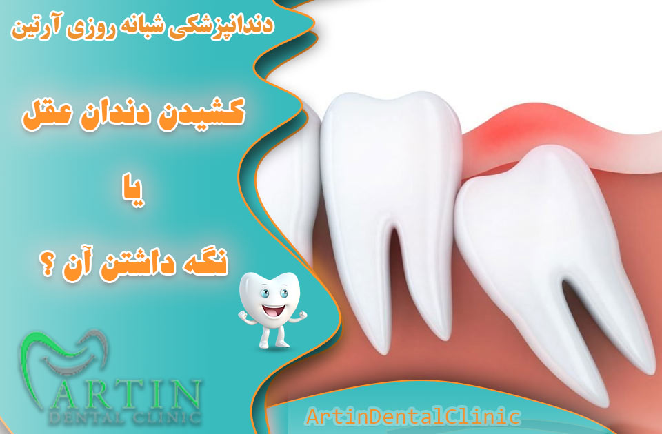 کشیدن دندان عقل یا نگه داشتن آن ؟