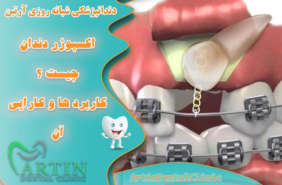 اکسپوژر دندان چیست؟ کاربردها و کارایی آن