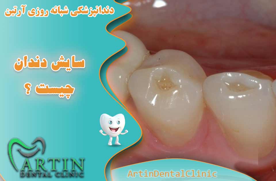 سایش دندان چیست ؟