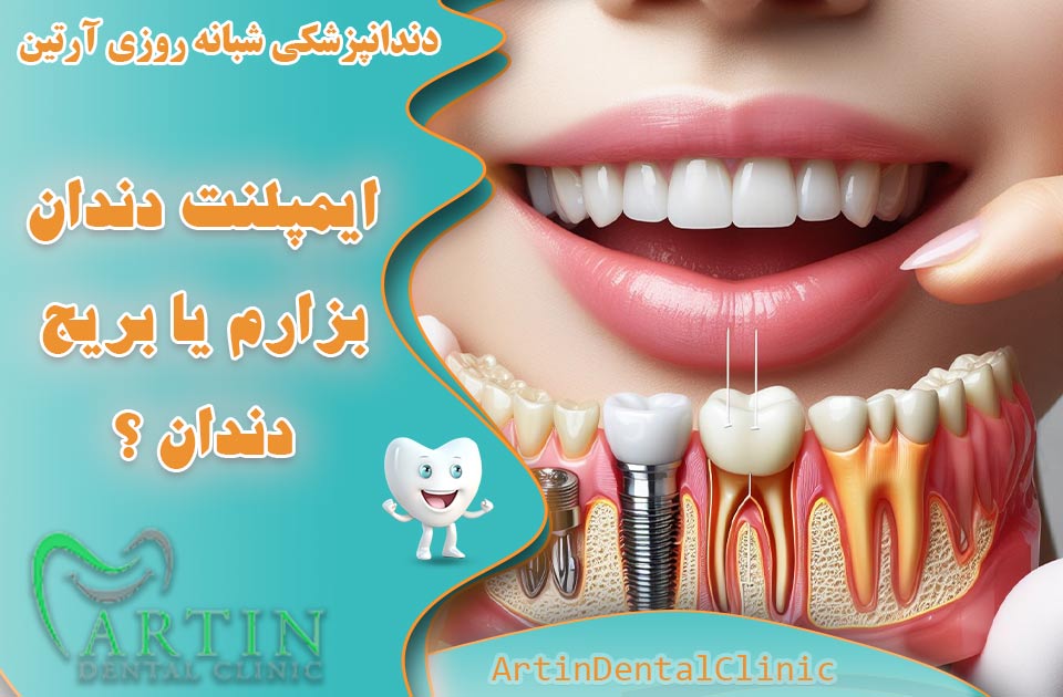 ایمپلنت دندان بزارم یا بریج دندان ؟ ( تفاوت ها ، مزایا و معایب )