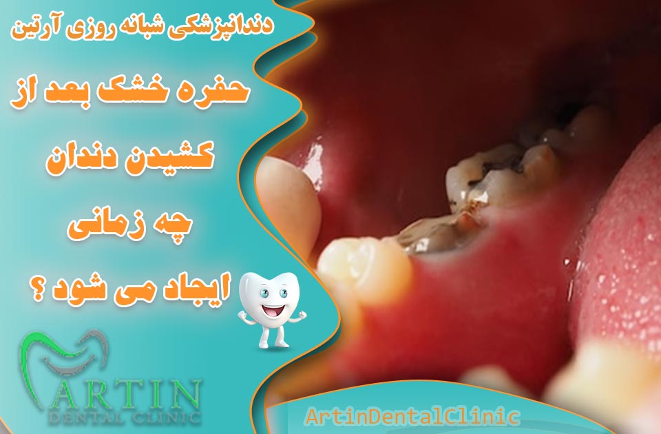 حفره خشک بعد از کشیدن دندان چه زمانی ایجاد می شود؟