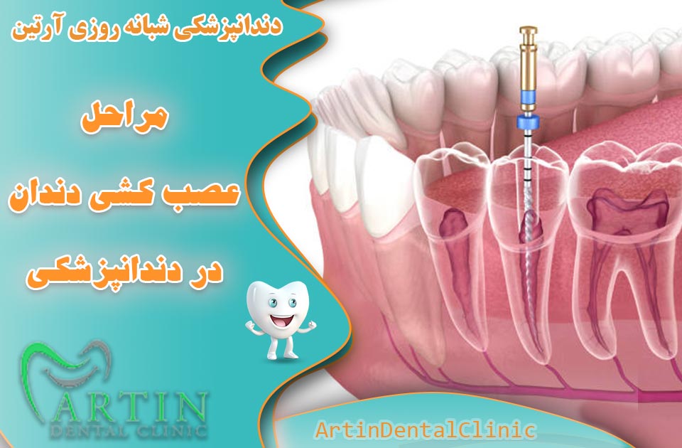 مراحل عصب‌کشی دندان در دندانپزشکی ( مراحل اصولی )