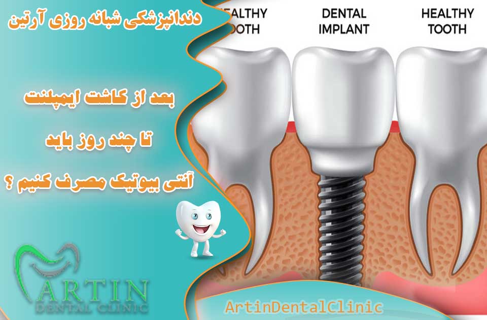 بعد از کاشت ایمپلنت چند روز آنتی بیوتیک بخوریم ؟