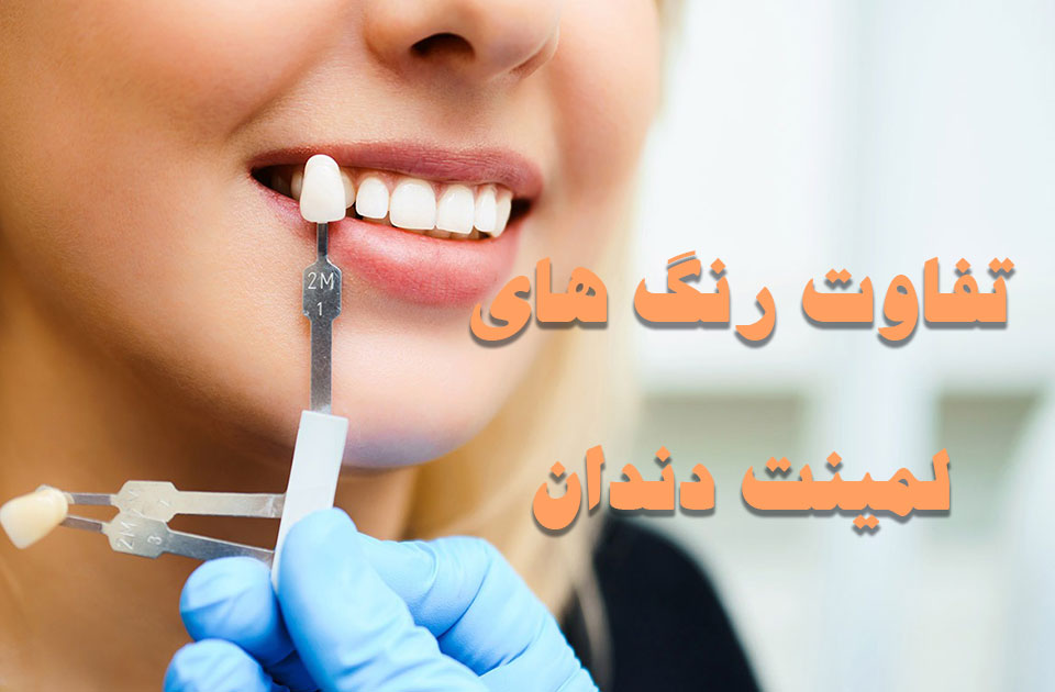 تفاوت های رنگ لمینت دندان