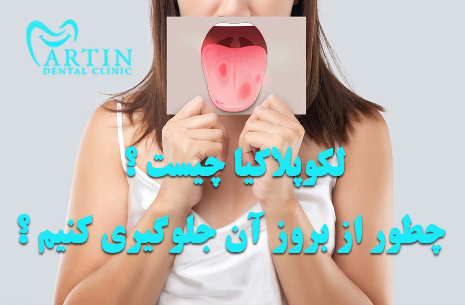 لکوپلاکیا چیست ؟ چگونگی پیشگیری از آن
