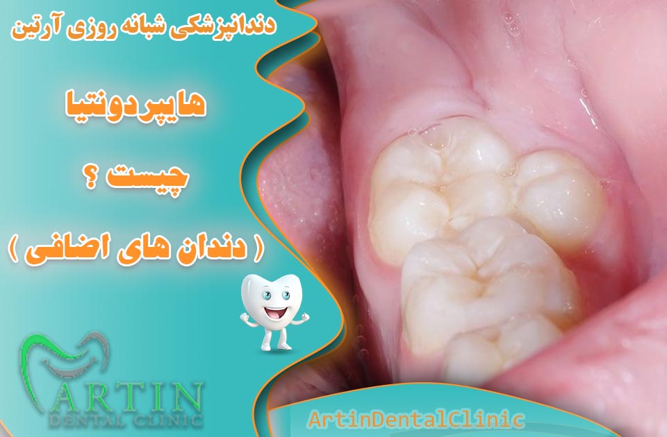هایپردونتیا چیست ؟ بررسی جامع دندان‌ های اضافی