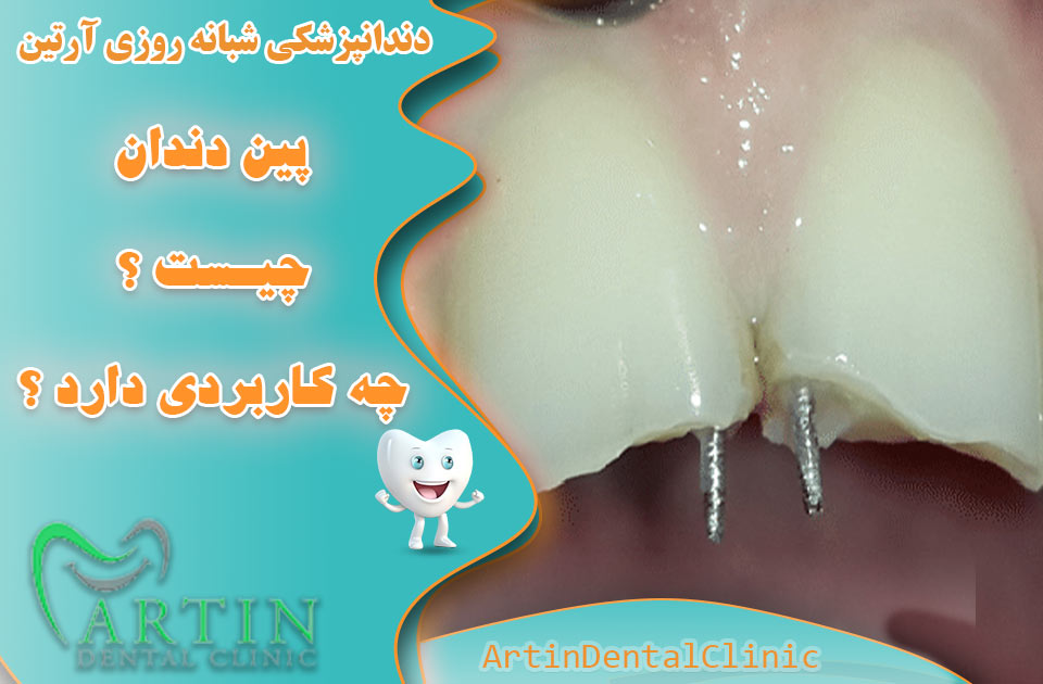 پین دندان چیست و چه کاربردی دارد ؟