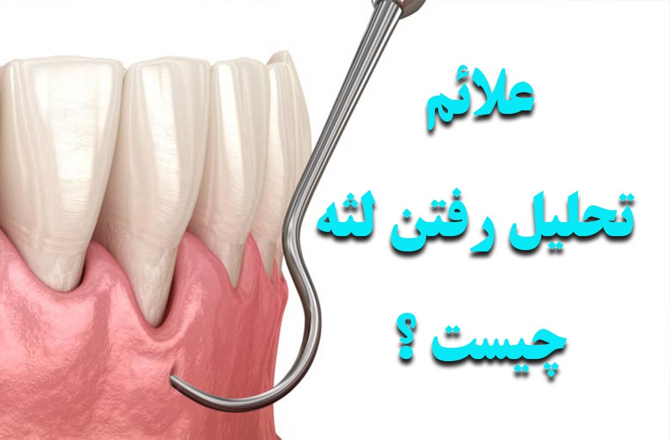 علائم تحلیل رفتن لثه چیست ؟