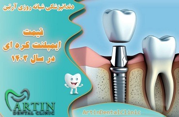 قیمت ایمپلنت کره ای در سال 1403