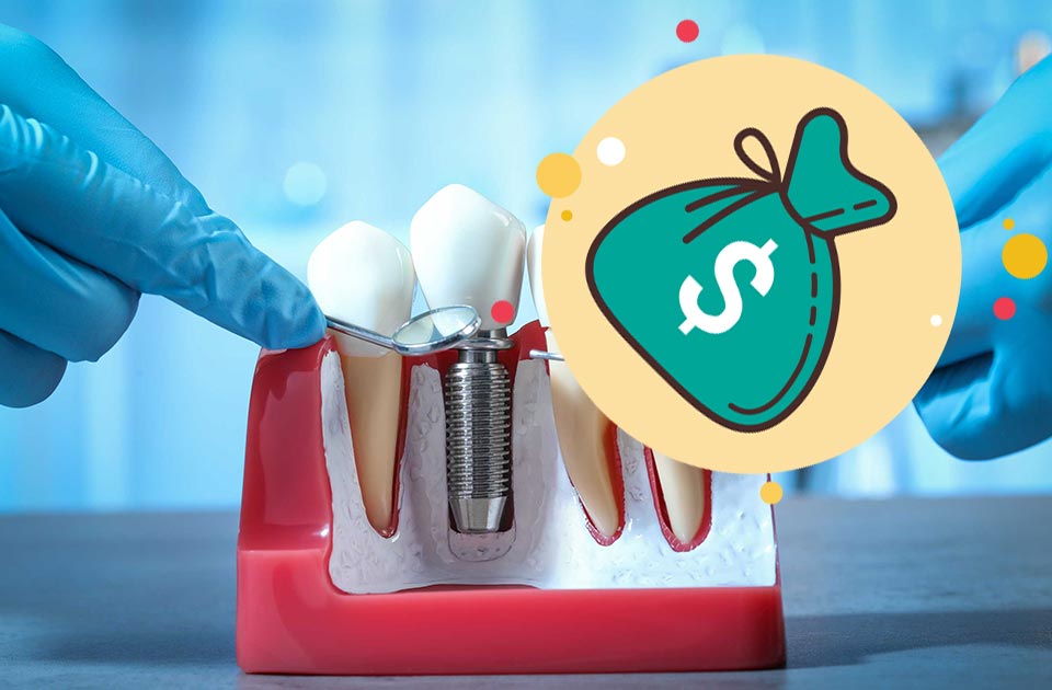 قیمت ایمپلنت کرج