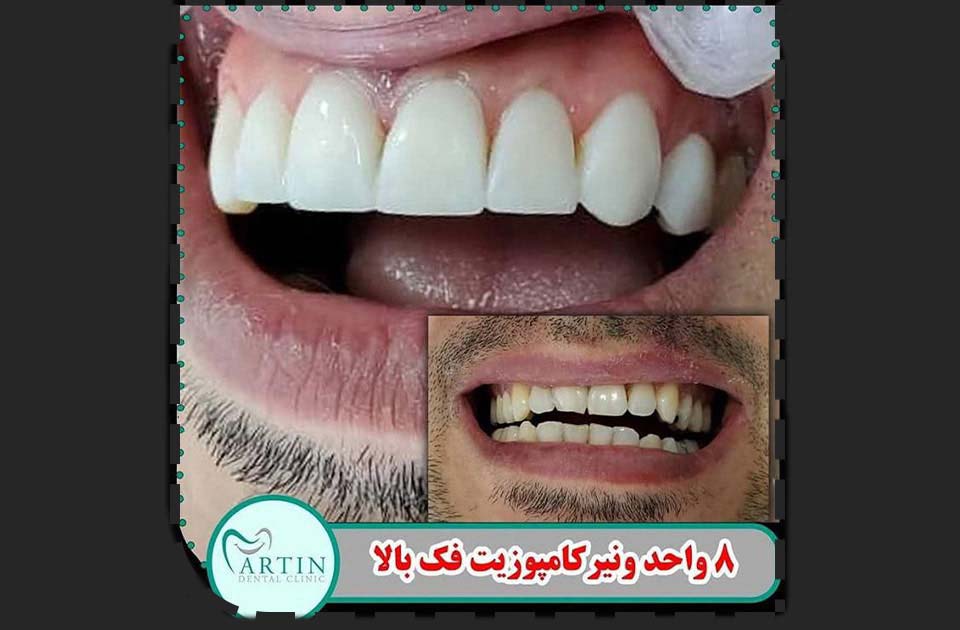 کامپوزیت دندان